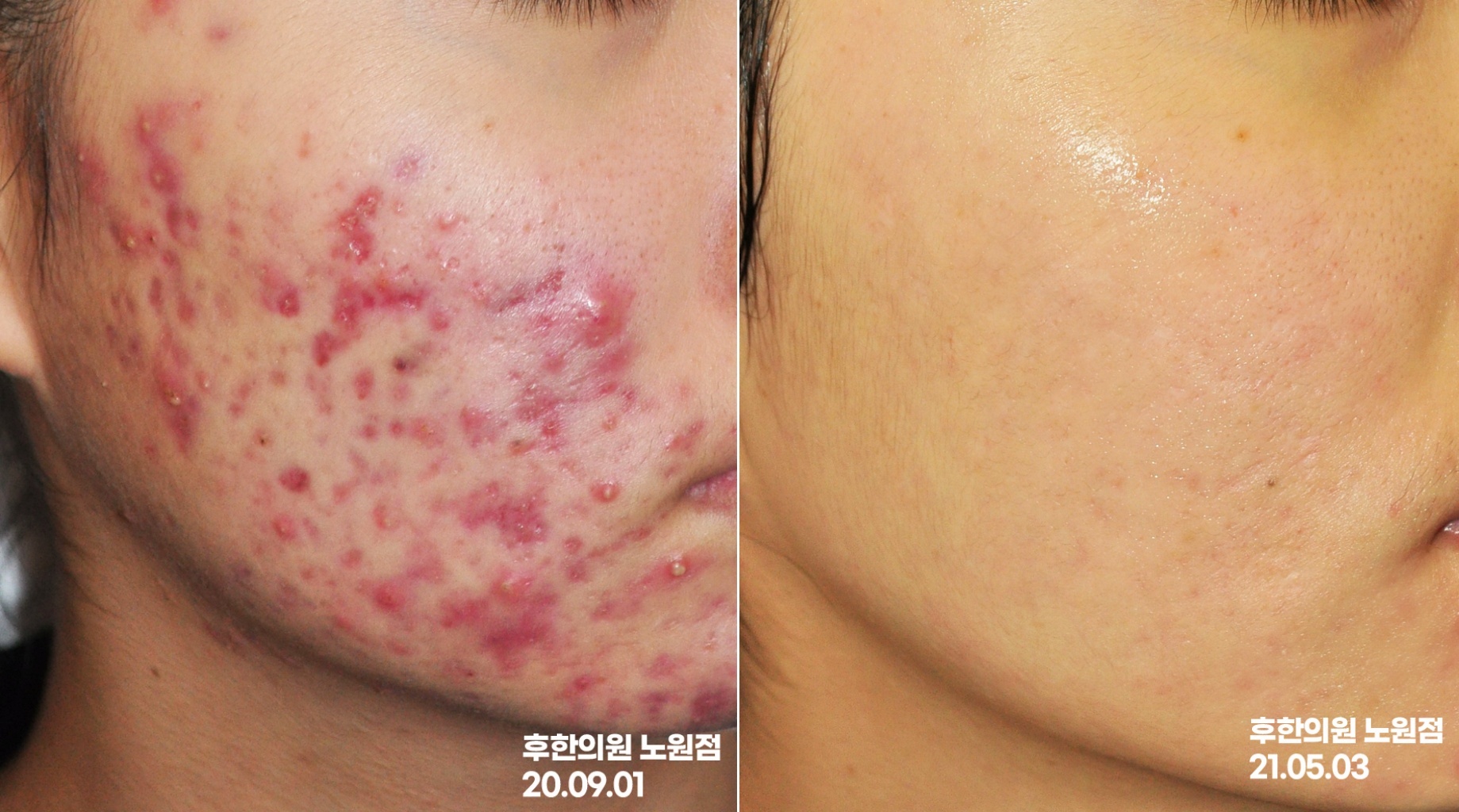 노원여드름한의원 화농성 여드름 치료 전후 사진