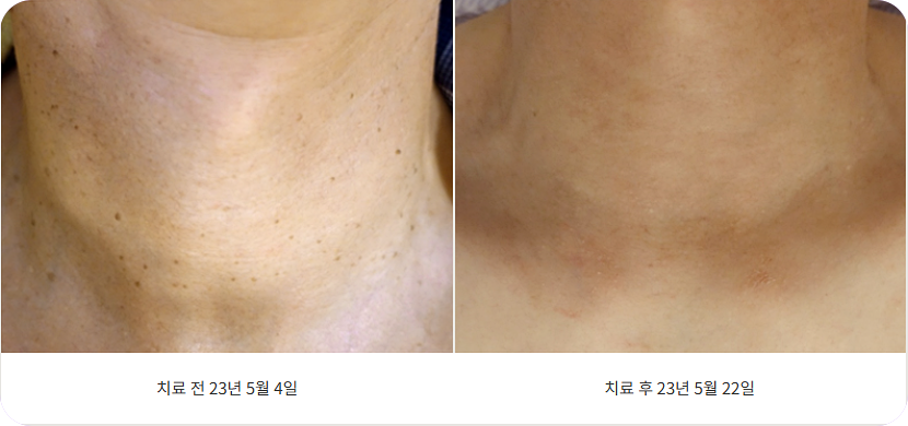 노원편평사마귀레이저 목 편평사마귀 제거 전과 후 이미지
