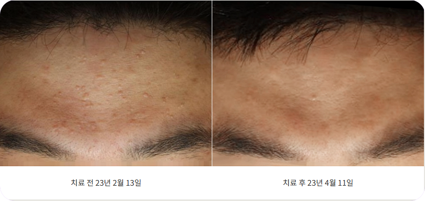 이마편평사마귀 제거 시술 전과 후 사진