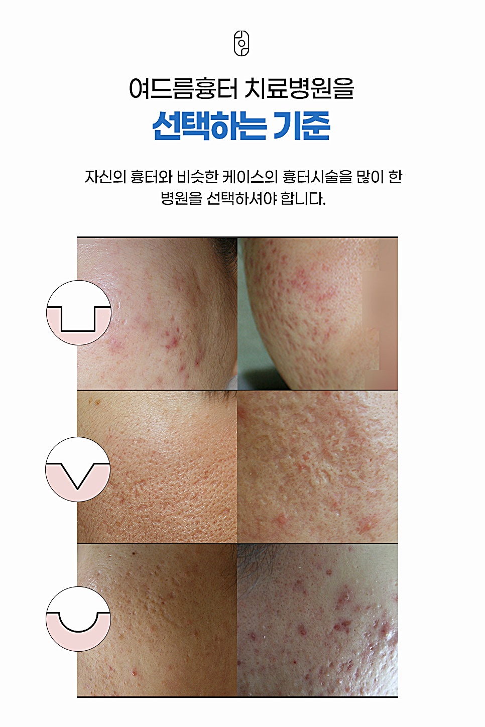 흉터 유형별(박스형·브이형·유자형) 치료 사례 비교 이미지
