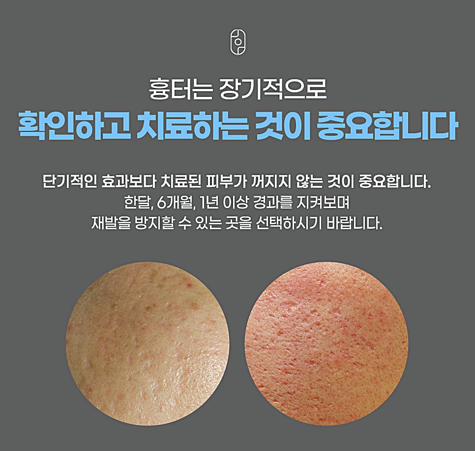 여드름흉터 치료 후 장기 경과 관리 안내 이미지