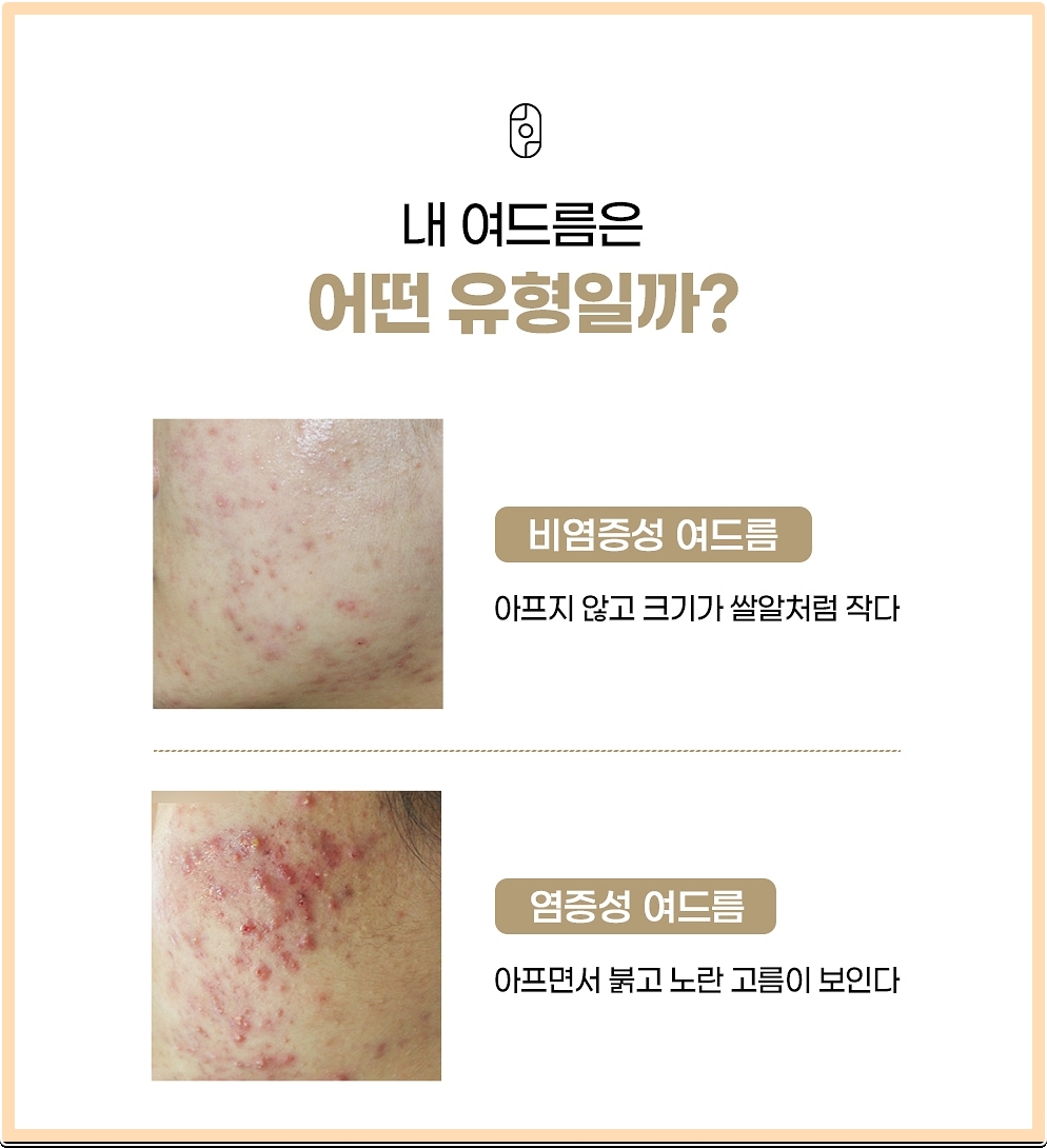 각 여드름 유형에 대한 특징 설명 이미지