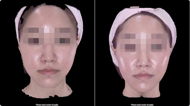노원안면비대칭한의원 3D 안면측정 치료 전후 비교 이미지, 광대 높이와 얼굴 대칭이 개선된 모습