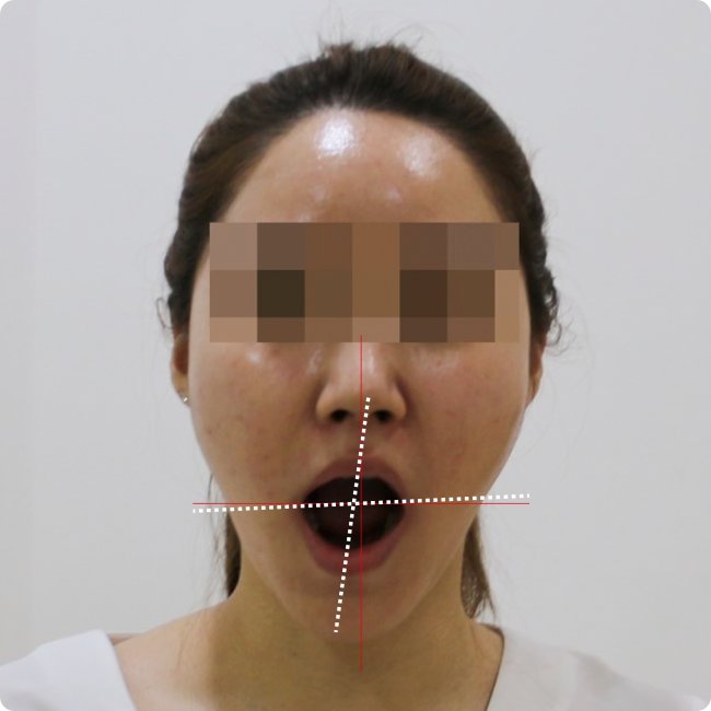 노원안면비대칭한의원 치료 후 입 벌렸을 때 턱이 중심으로 틀어진 사진