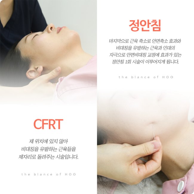 노원안면비대칭한의원 치료법 