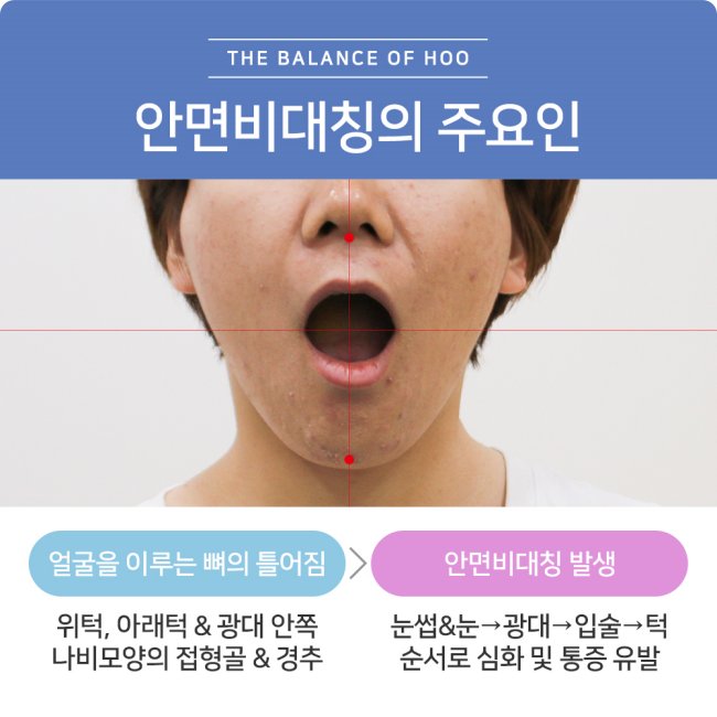 노원안면비대칭한의원 원인 