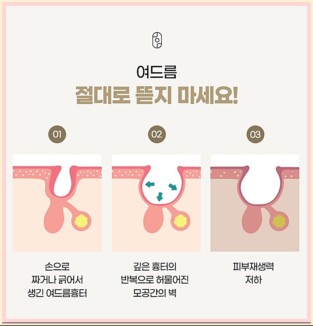 여드름을 뜯으면 생기는 일 