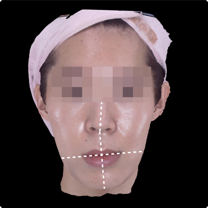  노원안면비대칭교정 치료 전 3D 안면 분석 - 입술과 턱 중심선이 한쪽으로 틀어진 모습