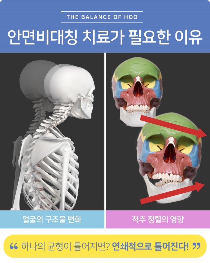 안면비대칭 치료가 필요한 이유 - 척추 정렬 불균형이 얼굴 비대칭으로 이어지는 원리