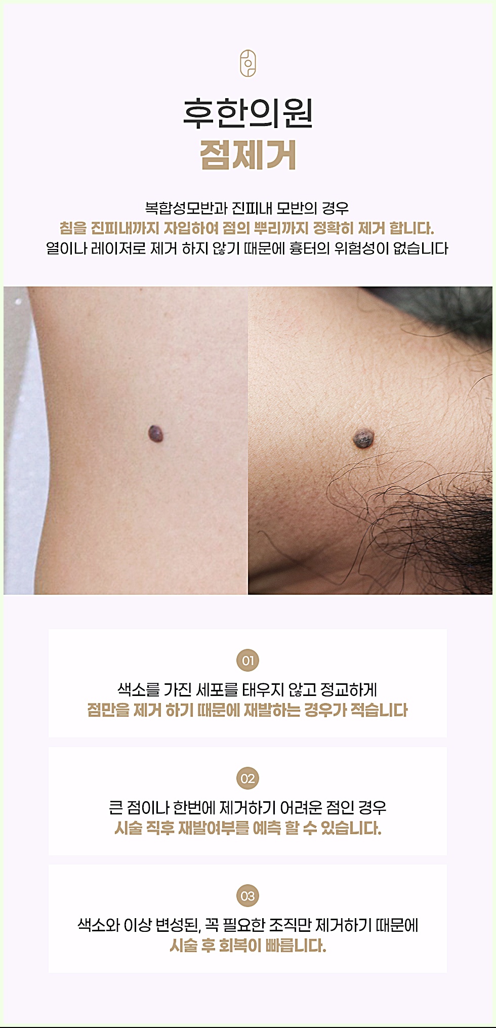 후한의원 점제거 설명 - 복합성모반, 진피내모반 침 제거 원리
