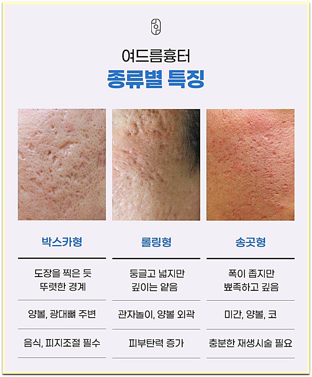 의정부여드름흉터 박스카형·롤링형·송곳형 종류별 특징 비교