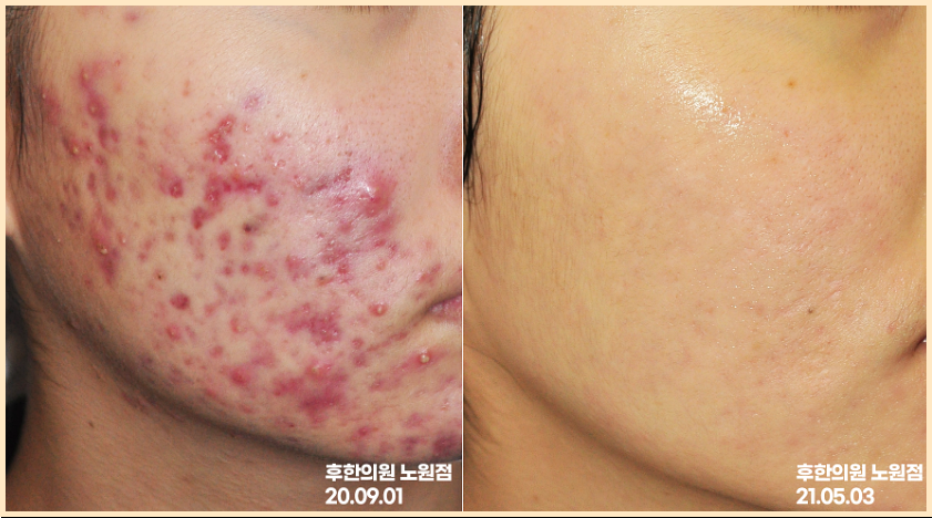 얼굴 여드름 치료 전후