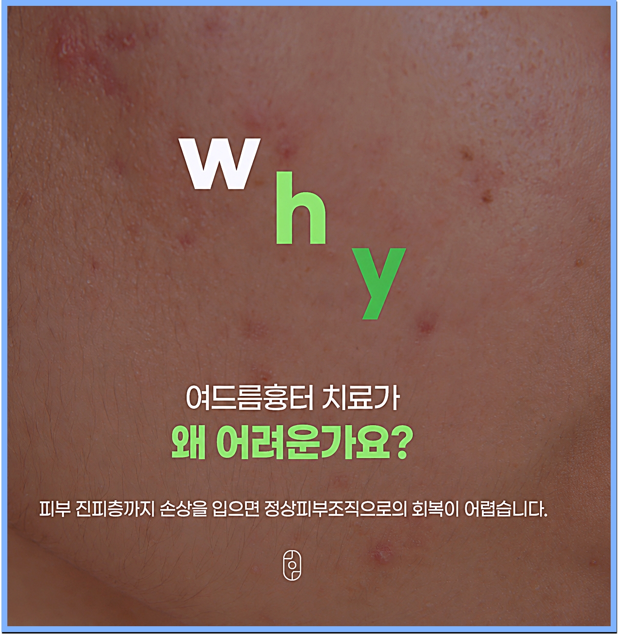 노원여드름흉터 치료가 어려운 이유를 설명하는 볼 피부 클로즈업