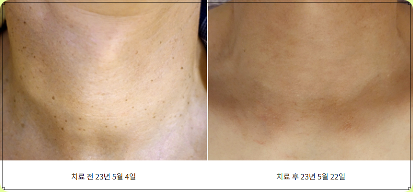 목 편평사마귀 제거 전후 비교