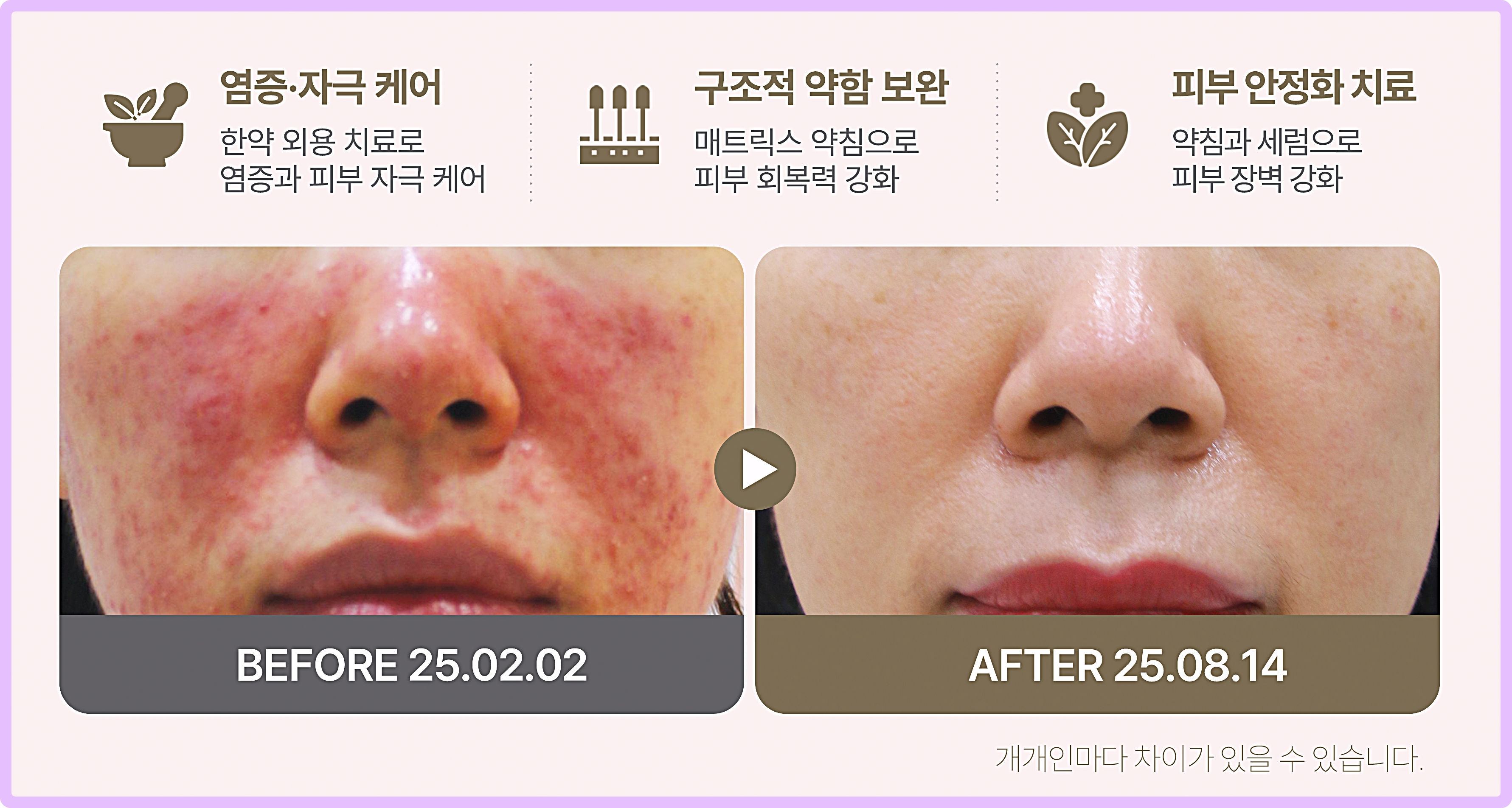 후한의원 노원점 주사피부염 한약 외용 매트릭스 약침 치료 구성 안내